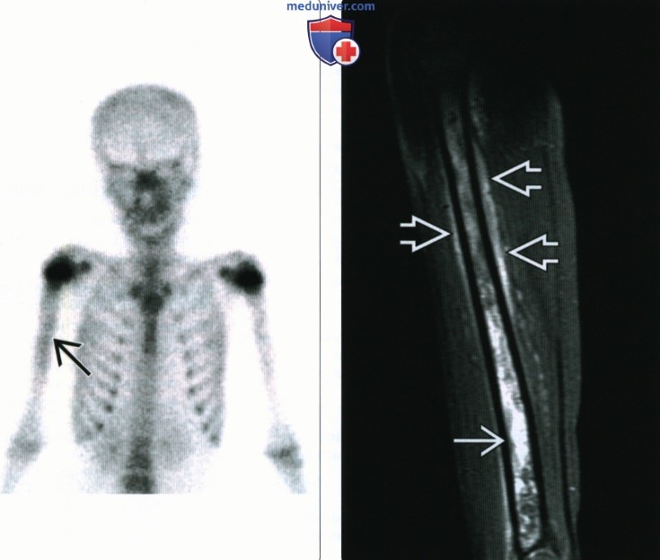 Рентгенограмма, КТ, МРТ при остром остеомиелите у детей