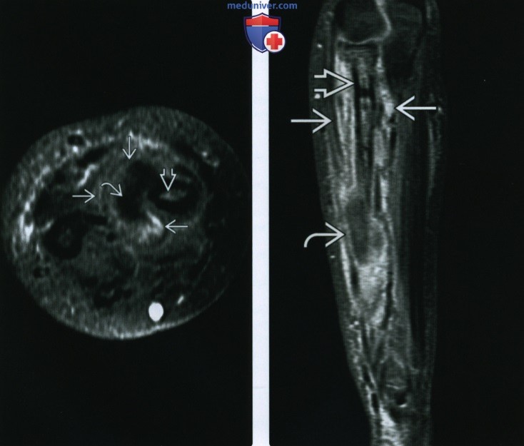Рентгенограмма, КТ, МРТ при остром остеомиелите у детей