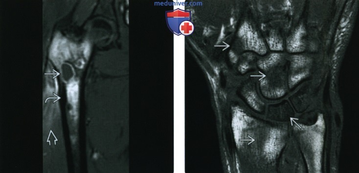 Рентгенограмма, КТ, МРТ при остром остеомиелите у взрослых