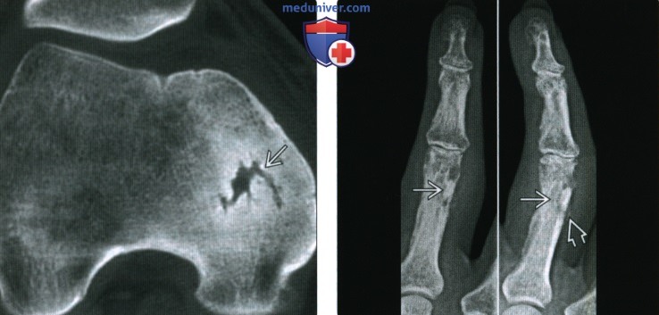 Рентгенограмма, КТ, МРТ при остром остеомиелите у взрослых