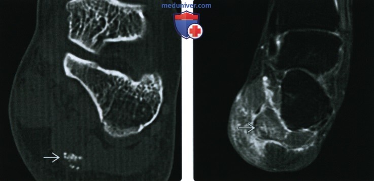 Рентгенограмма, КТ, МРТ при болезни отложения кристаллов, симулирующей опухоль мягких тканей