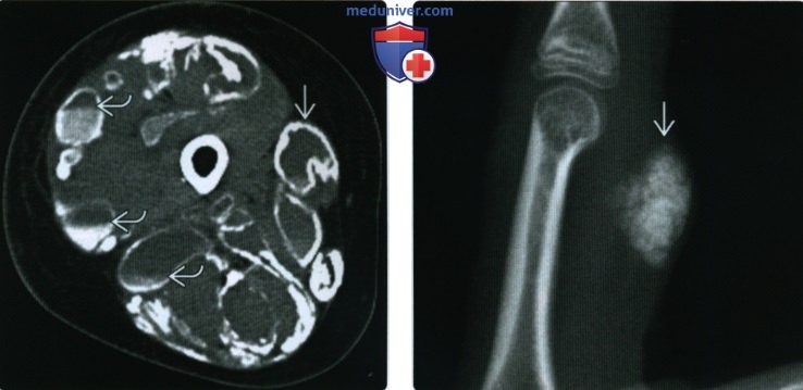 Рентгенограмма, КТ, МРТ при болезни отложения кристаллов, симулирующей опухоль мягких тканей