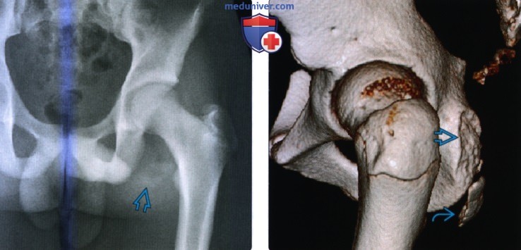 Рентгенограмма, КТ, МРТ при отрывном переломе таза и/или апофизите