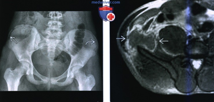 Рентгенограмма, КТ, МРТ при отрывном переломе таза и/или апофизите