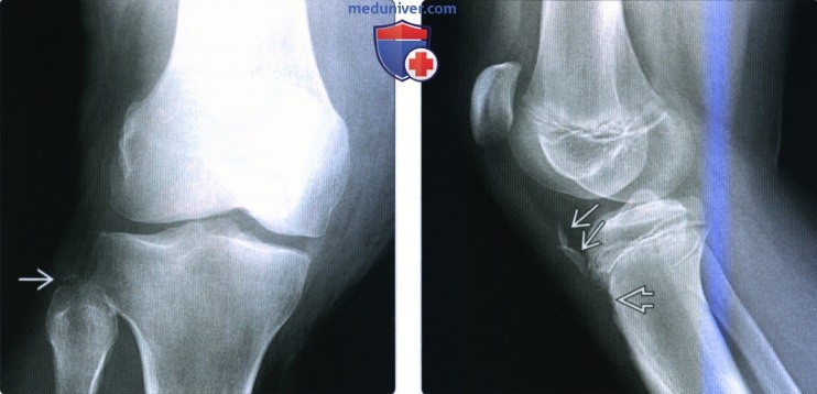 Рентгенограмма, КТ, МРТ при отрывной травме колена