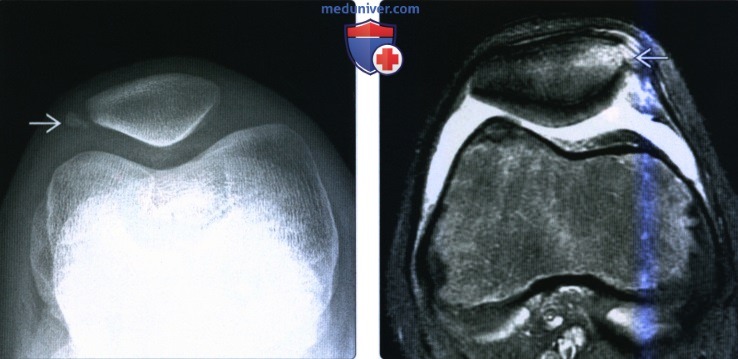 Рентгенограмма, КТ, МРТ при отрывной травме колена