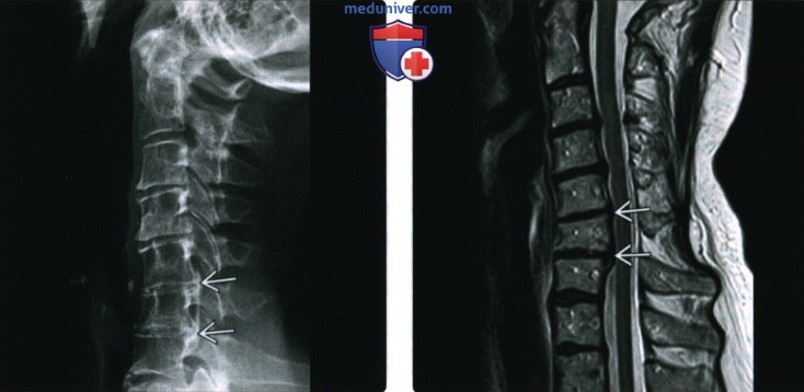 Рентгенограмма, КТ, МРТ при оссификации задней продольной связки (ОЗПС)