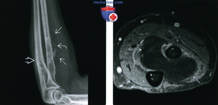 Рентгенограмма, КТ, МРТ при паростальной липоме
