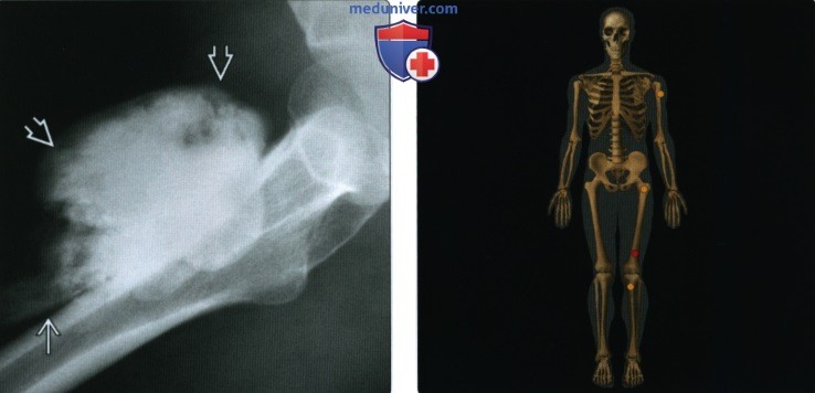 Рентгенограмма, КТ, МРТ при паростальной остеосаркоме