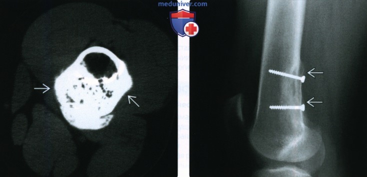 Рентгенограмма, КТ, МРТ при паростальной остеосаркоме