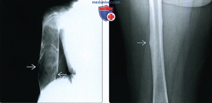 Рентгенограмма, КТ, МРТ при патологическом переломе кости