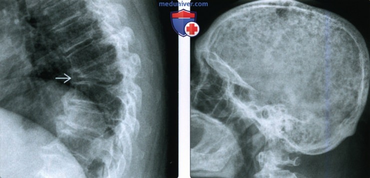 Рентгенограмма, КТ, МРТ при патологическом переломе кости