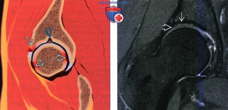 Рентгенограмма, КТ, МРТ при хрящевой и костно-хрящевой патологии тазобедренного сустава