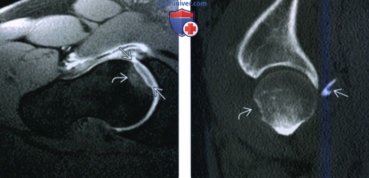 Рентгенограмма, КТ, МРТ при хрящевой и костно-хрящевой патологии тазобедренного сустава