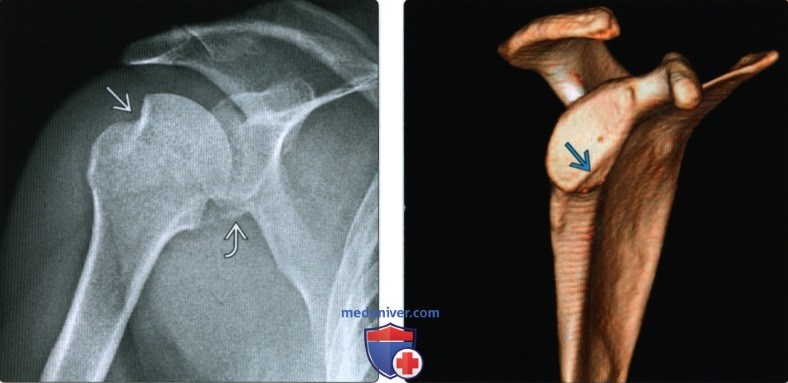 Рентгенограмма, КТ, МРТ при переднем вывихе плеча