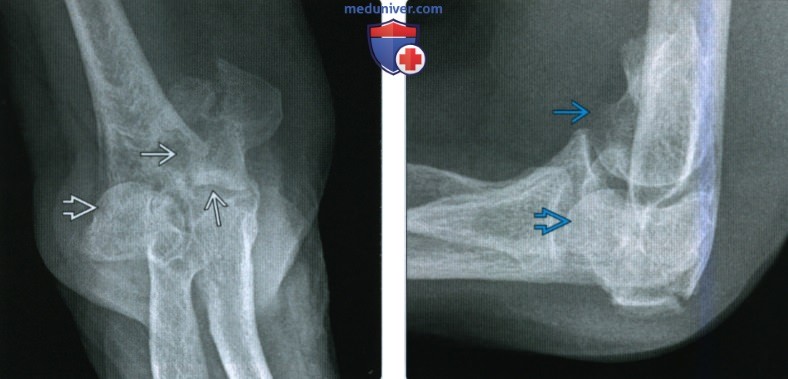 Рентгенограмма, КТ, МРТ при переломе дистального конца плечевой кости
