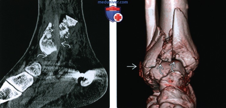 Рентгенограмма, КТ, МРТ при переломе дистального метаэпифиза большеберцовой кости