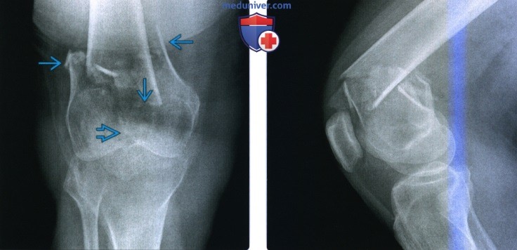 Рентгенограмма, КТ, МРТ при переломе дистального отдела бедренной кости