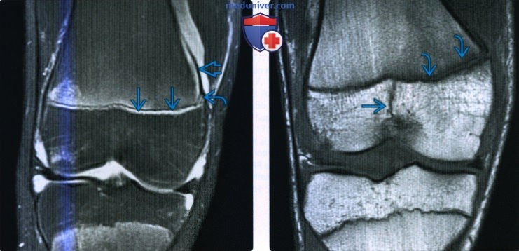 Рентгенограмма, КТ, МРТ при переломе дистального отдела бедренной кости