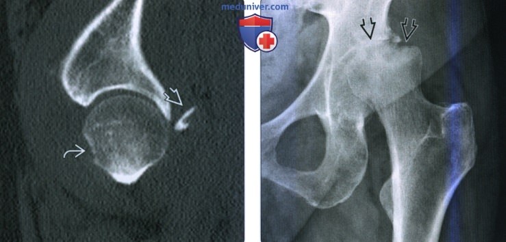 Рентгенограмма, КТ, МРТ при переломе головки бедренной кости