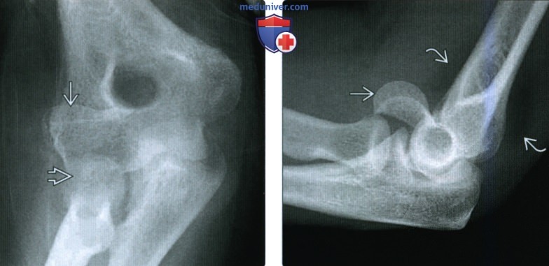 Рентгенограмма, КТ, МРТ при переломе головки мыщелка плечевой кости