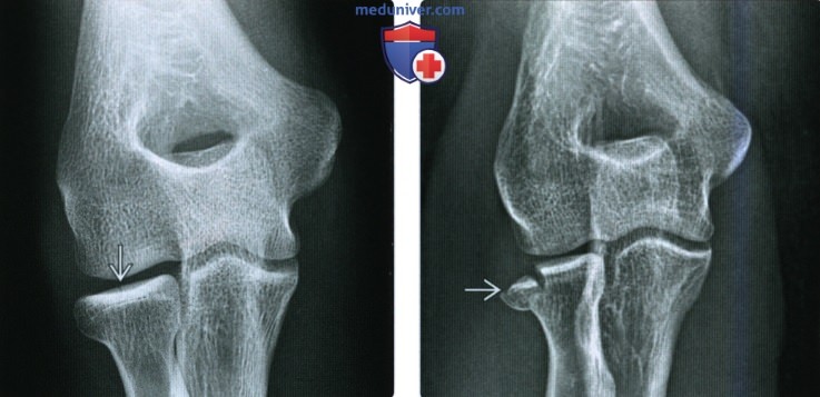 Рентгенограмма, КТ, МРТ при переломе головки и/или шейки лучевой кости
