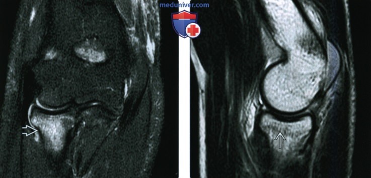 Рентгенограмма, КТ, МРТ при переломе головки и/или шейки лучевой кости