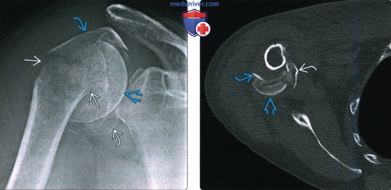 Рентгенограмма, КТ, МРТ при переломе головки и шейки плечевой кости