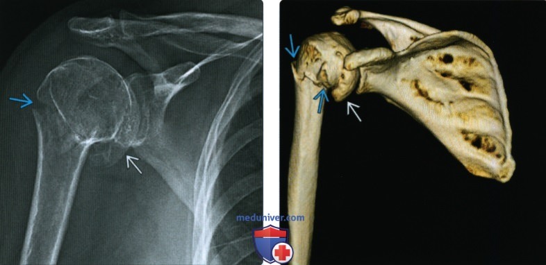 Рентгенограмма, КТ, МРТ при переломе головки и шейки плечевой кости