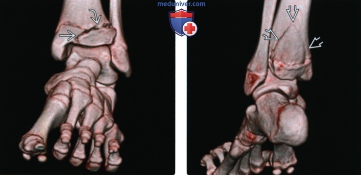 Рентгенограмма, КТ, МРТ при переломе костей голеностопного сустава по Салтеру-Харрису