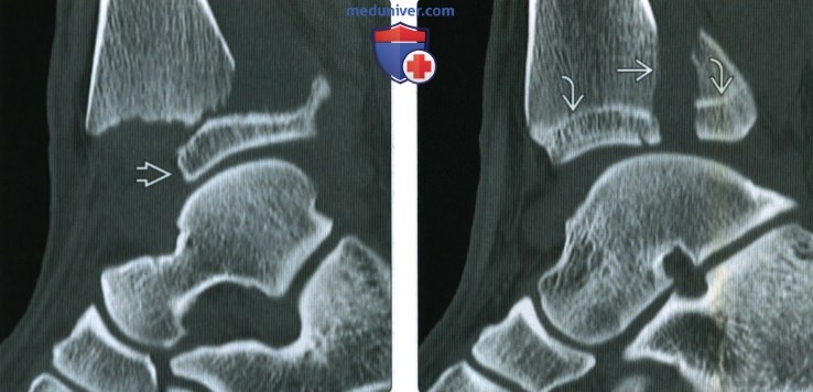 Рентгенограмма, КТ, МРТ при переломе костей голеностопного сустава по Салтеру-Харрису