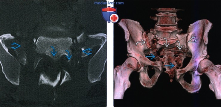 Рентгенограмма, КТ, МРТ при травматическом переломе крестца