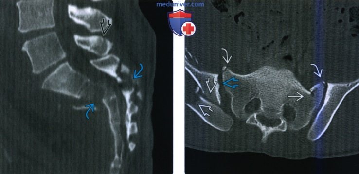 Рентгенограмма, КТ, МРТ при травматическом переломе крестца