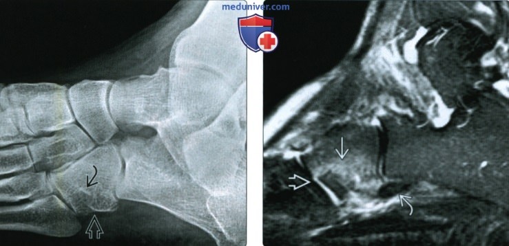 Рентгенограмма, КТ, МРТ при переломе кубовидной кости