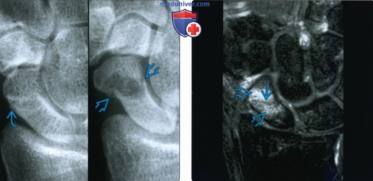 Рентгенограмма, КТ, МРТ при переломе ладьевидной кости