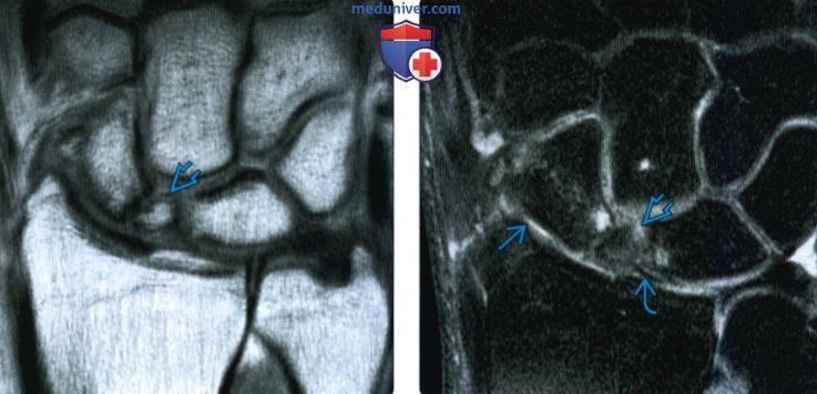 Рентгенограмма, КТ, МРТ при переломе ладьевидной кости