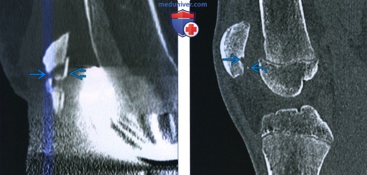 Рентгенограмма, КТ, МРТ при переломе надколенника