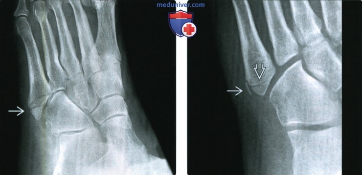 Рентгенограмма, КТ, МРТ при переломе плюсневых костей