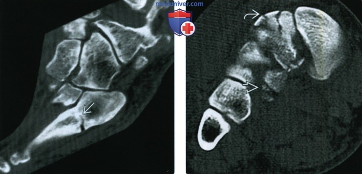 Рентгенограмма, КТ, МРТ при переломе плюсневых костей