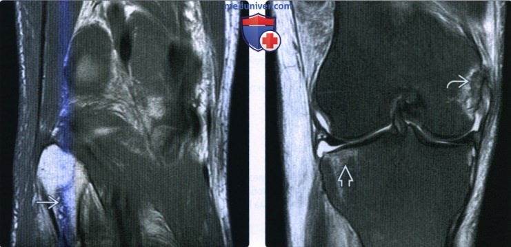Рентгенограмма, КТ, МРТ при переломе проксимального большеберцово-малоберцового сустава и проксимального отдела малоберцовой кости
