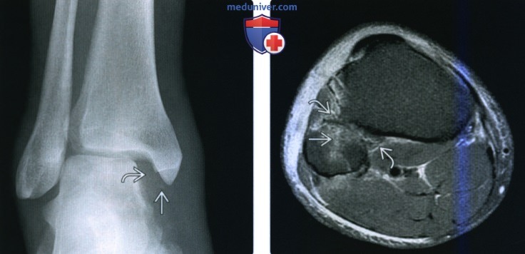 Рентгенограмма, КТ, МРТ при переломе проксимального большеберцово-малоберцового сустава и проксимального отдела малоберцовой кости
