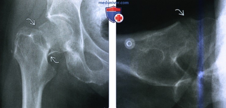 Рентгенограмма, КТ, МРТ при переломе шейки бедренной кости