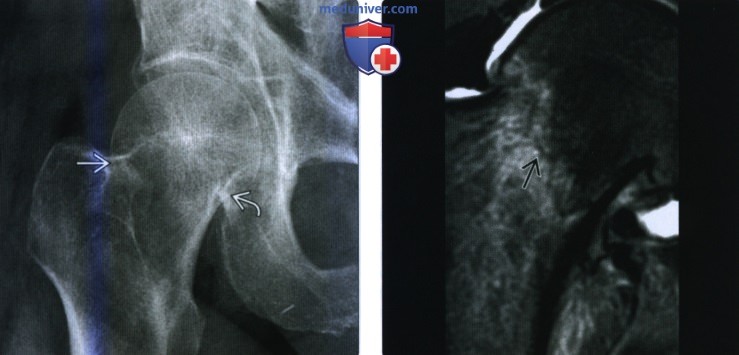 Рентгенограмма, КТ, МРТ при переломе шейки бедренной кости