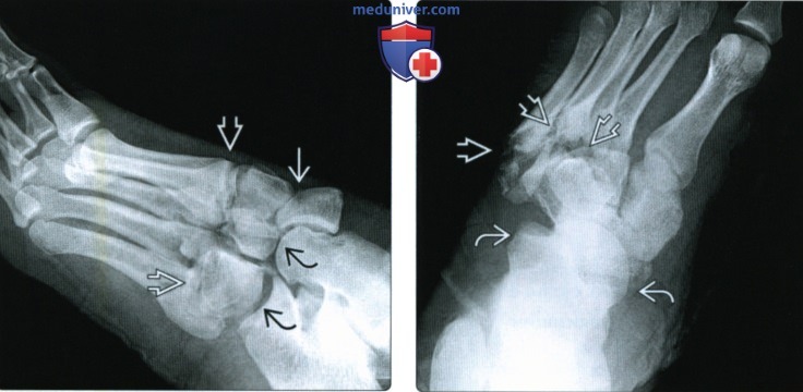 Рентгенограмма, КТ, МРТ при переломовывихе сустава Лисфранка