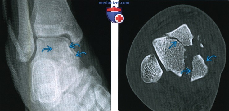 Рентгенограмма, КТ, МРТ при переломе тела и отростков таранной кости