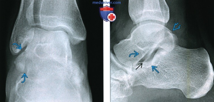 Рентгенограмма, КТ, МРТ при переломе тела и отростков таранной кости