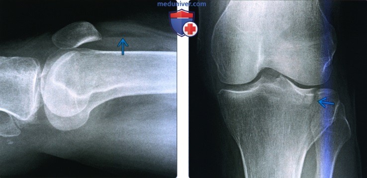 Рентгенограмма, КТ, МРТ при переломе верхней суставной поверхности большеберцовой кости
