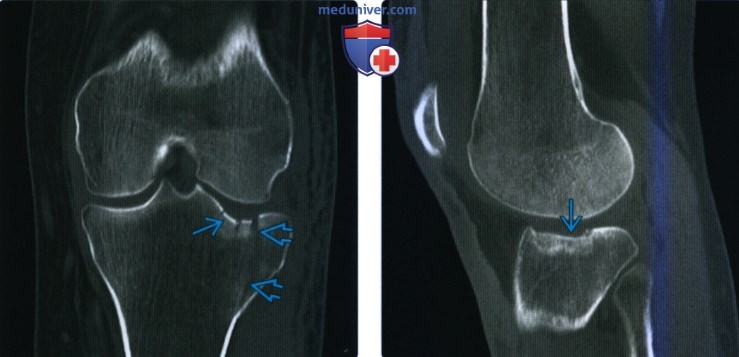 Рентгенограмма, КТ, МРТ при переломе верхней суставной поверхности большеберцовой кости