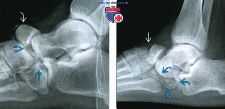 Рентгенограмма, КТ, МРТ при переломе и вывихе ладьевидной кости