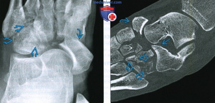 Рентгенограмма, КТ, МРТ при переломе и вывихе ладьевидной кости